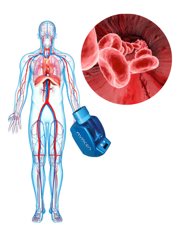blood circulation with AVACEN® Medical device
